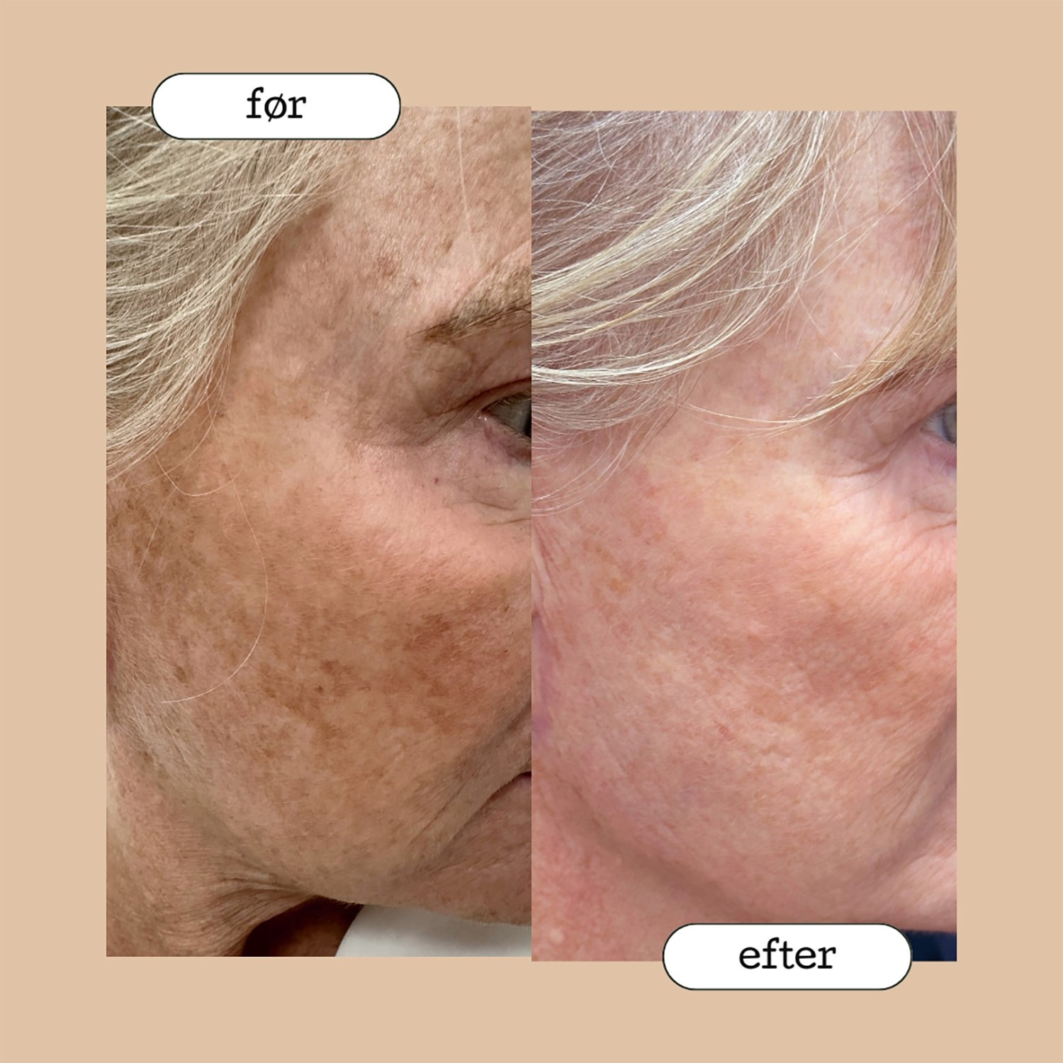 kemisk_peeling_333_338